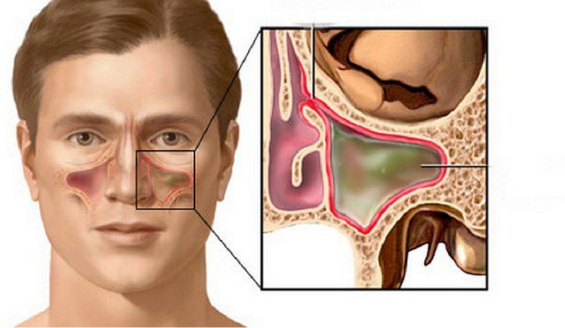 Tìm hiểu về phương pháp chụp X-quang Hirtz trong chẩn đoán viêm xoang 3