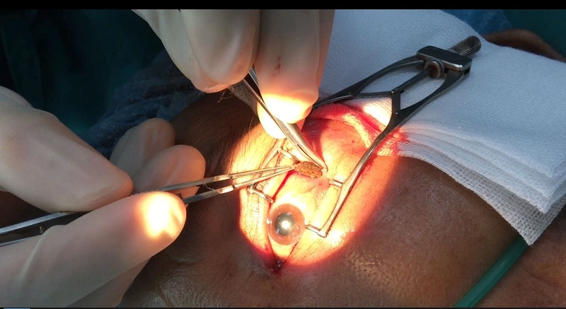 Tìm hiểu về phương pháp phẫu thuật u hốc mắt là gì? Quy trình thực hiện ra sao? 3