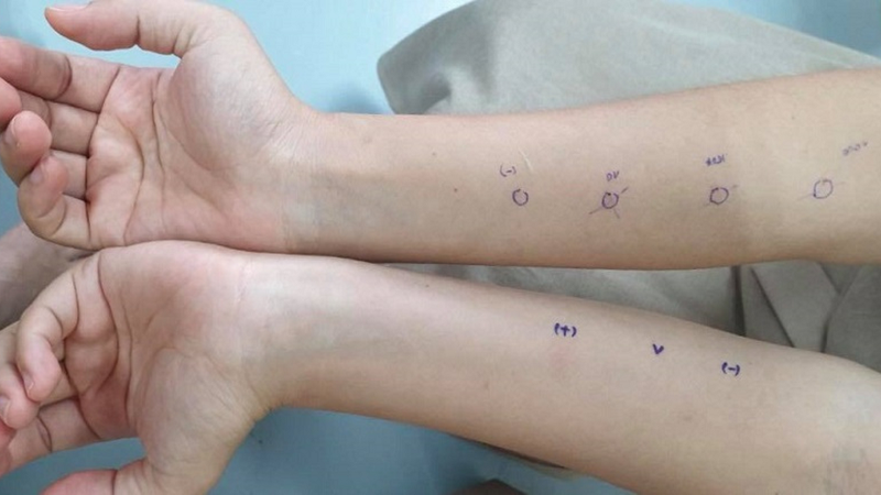 Tìm hiểu về phương pháp test dị ứng kháng sinh và quy trình thực hiện 1