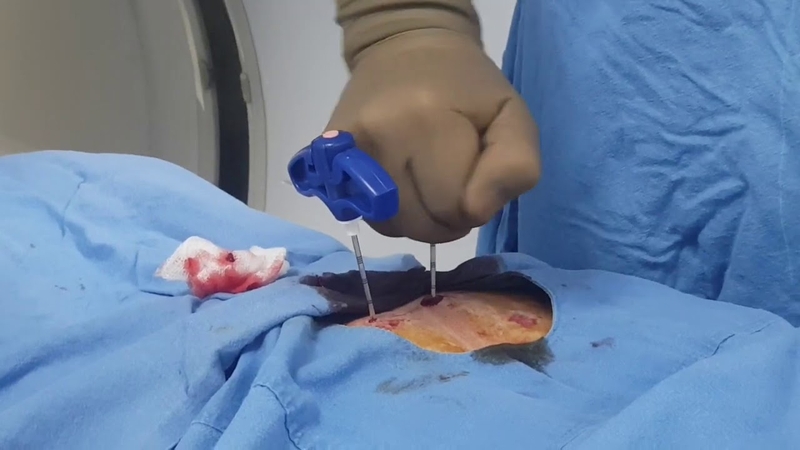 Tìm hiểu về sinh thiết cột sống dưới cắt lớp vi tính 3