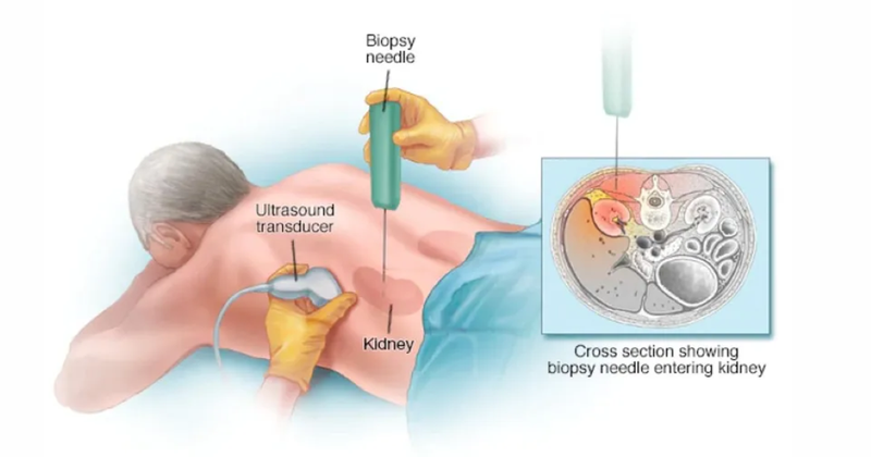 Tìm hiểu về sinh thiết thận dưới hướng dẫn siêu âm 2