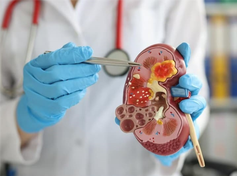 Tìm hiểu về sinh thiết thận dưới hướng dẫn siêu âm 3