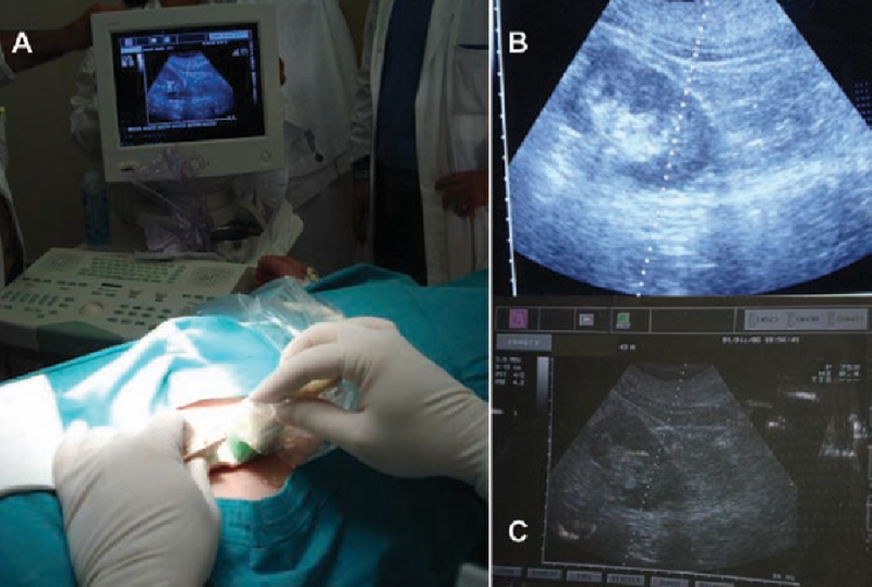 Tìm hiểu về sinh thiết thận dưới hướng dẫn siêu âm 4
