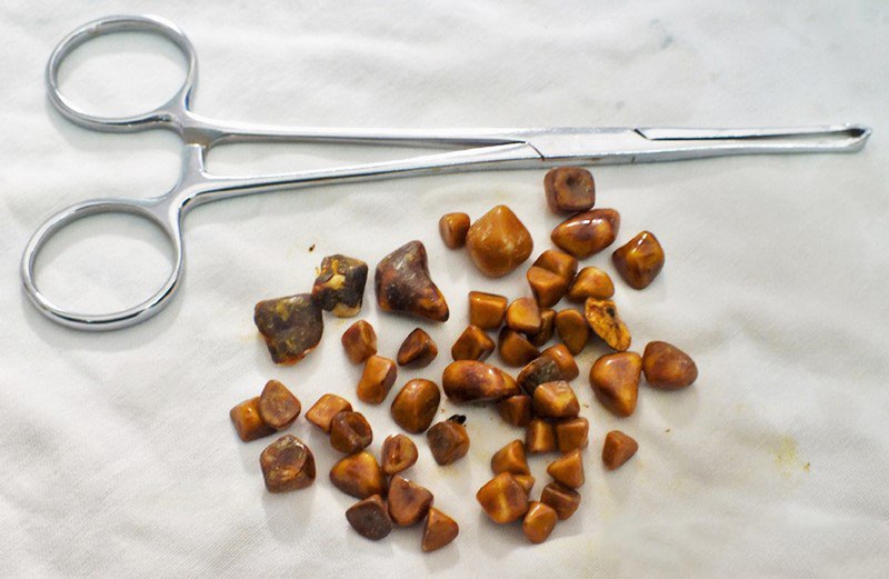 Tìm hiểu về sỏi mật sắc tố