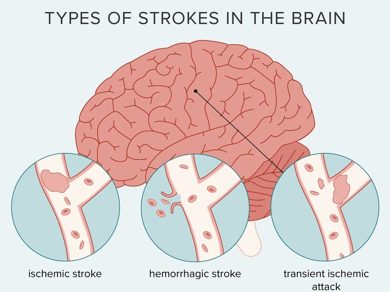 Tìm hiểu về sự hình thành cục máu đông trong tai biến mạch máu não 1