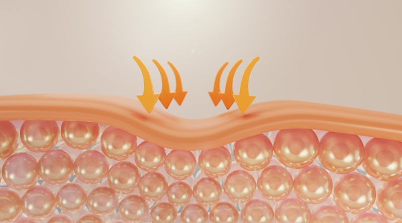 Tìm hiểu về tác hại của nâng cơ hifu trong thẩm mỹ da 3