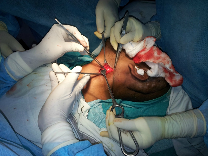 Tìm hiểu về thắt động mạch cảnh ngoài 1