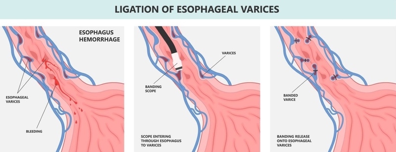 Tìm hiểu thắt tĩnh mạch thực quản qua nội soi 3