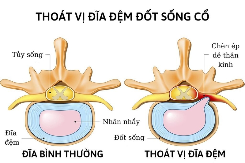 Tìm hiểu về thoái hoá đốt sống cổ và thoát vị đĩa đệm 2