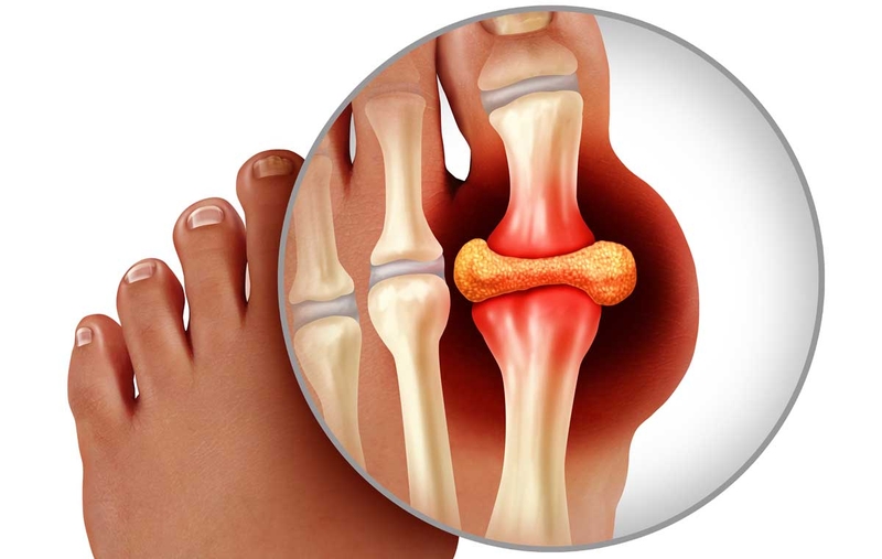 Tìm hiểu về tinh thể urat ở người bị bệnh Gout 1