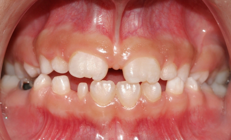 Tìm hiểu về tình trạng bị răng nhỏ1