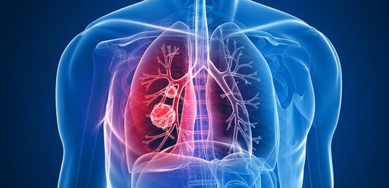 Tìm hiểu về ung thư phổi di căn hạch trung thất