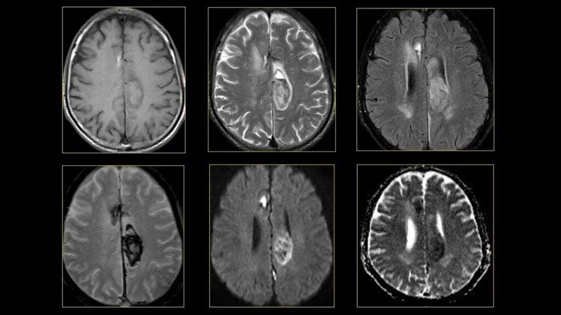 Tìm hiểu về vai trò của chụp MRI u màng não trong chẩn đoán bệnh  4