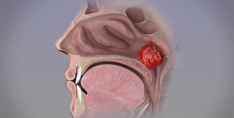 Tìm hiểu về viêm VA mạn tính ở người lớn 1