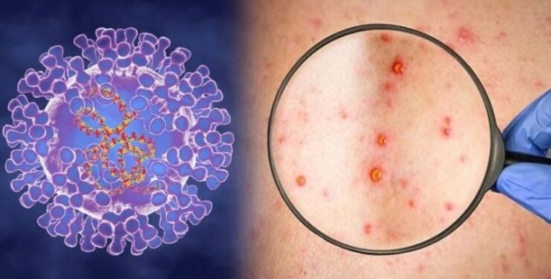 Tìm hiểu về virus đậu mùa khỉ1