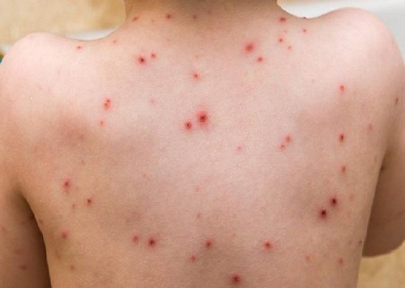 Tìm hiểu về virus đậu mùa khỉ2