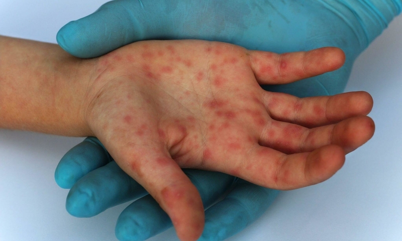 Tìm hiểu về virus đậu mùa khỉ3