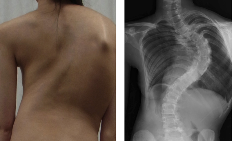 Tìm hiểu: Vẹo cột sống ở thanh thiếu niên và cách điều trị 2