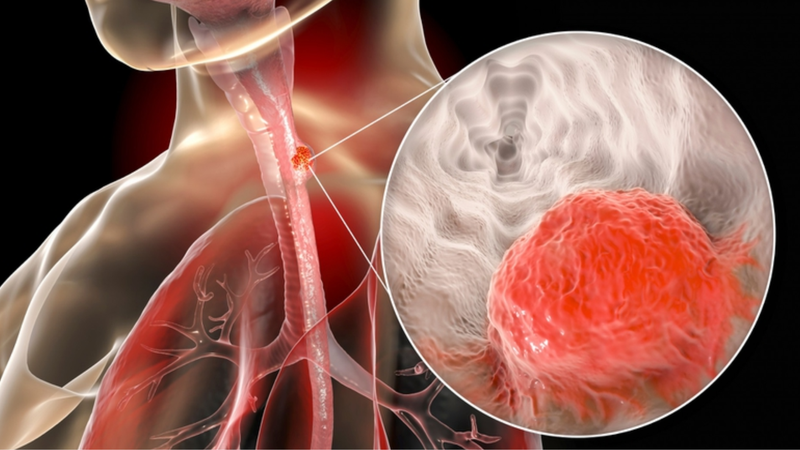 Xạ trị ung thư thực quản và những thông tin quan trọng cần biết 1