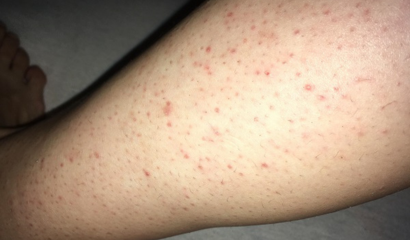 Bệnh viêm lỗ chân lông ở bắp chân là gì?