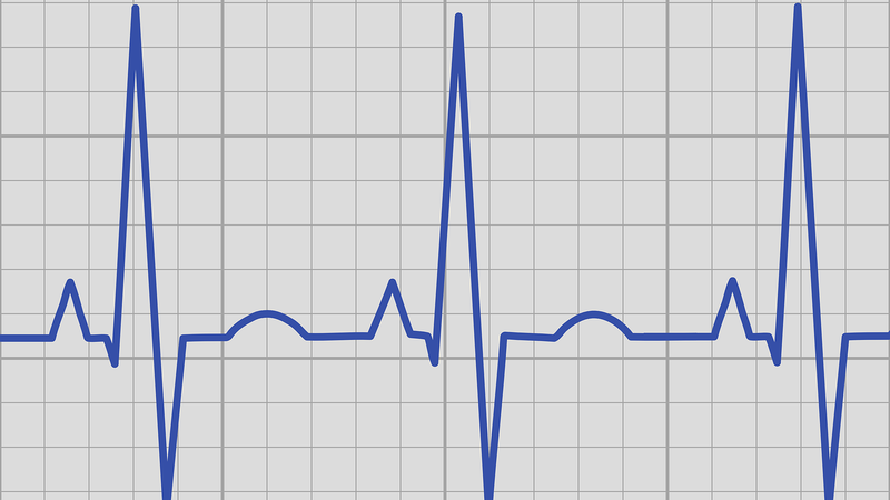 Đo điện tâm đồ là chỉ định cận lâm sàng thường quy giúp chẩn đoán tim nằm bên phải