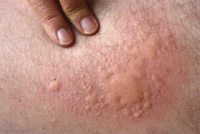 Nổi mề đay ở mông là tình trạng mẩn ngứa dị ứng trên vùng da mông