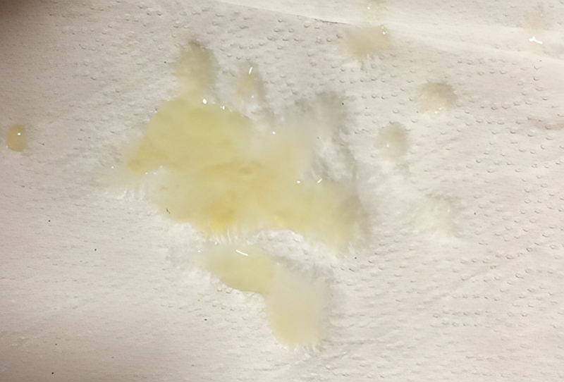 Tinh dịch màu vàng là biểu hiện của bệnh tăng bạch cầu