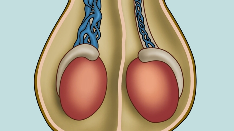 Giãn tĩnh mạch thừng tinh làm dòng máu lưu thông kém và ứ đọng quanh tinh hoàn