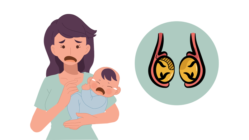 Tinh hoàn trẻ sơ sinh bị xệ: Dấu hiệu nhận biết, nguyên nhân và hướng điều trị 1