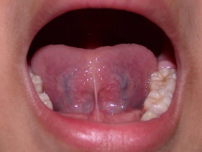 Tĩnh mạch dưới lưỡi màu đen có phải dấu hiệu cảnh báo vấn đề sức khoẻ nguy hiểm 1