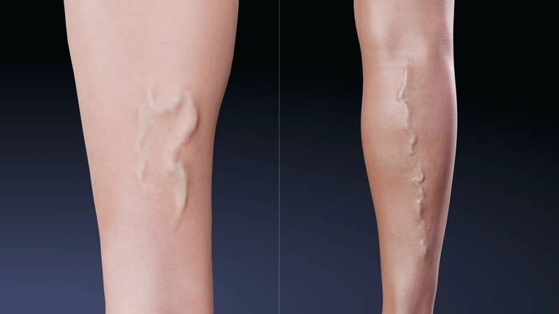 Suy giãn tĩnh mạch hiển lớn là bệnh lý phổ biến