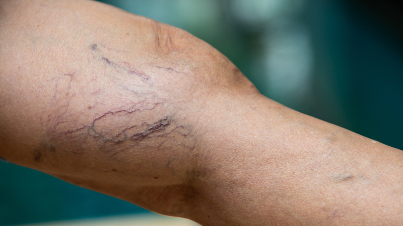 tinh-mach-mang-nhen-nguyen-nhan-va-cach-phong-tranh 1