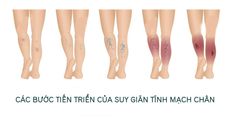 tinh-mach-mang-nhen-nguyen-nhan-va-cach-phong-tranh 2