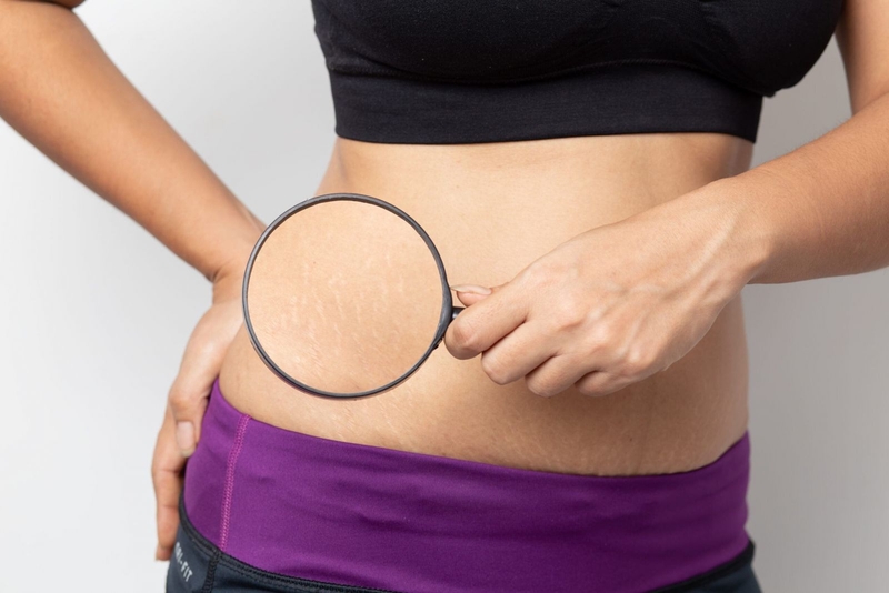 Hoạt chất curcumin có trong nghệ giúp kích thích tái tạo tế bào da, từ đó giúp giảm rạn da khi mang thai