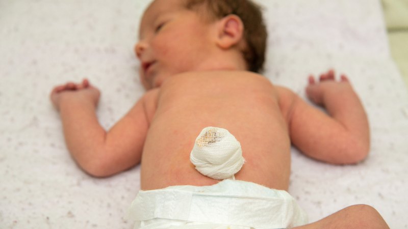 Tình trạng chồi rốn​ ở trẻ sơ sinh 4