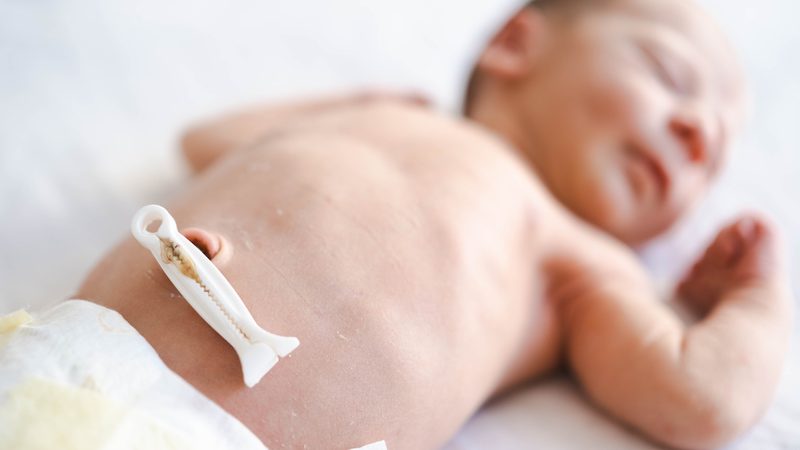 Tình trạng chồi rốn​ ở trẻ sơ sinh 3