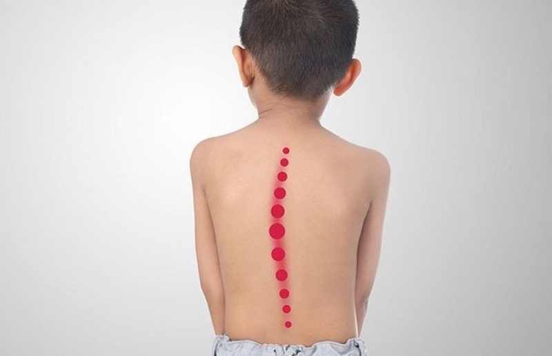 Tình trạng cong vẹo cột sống học đường đáng lo ngại 1