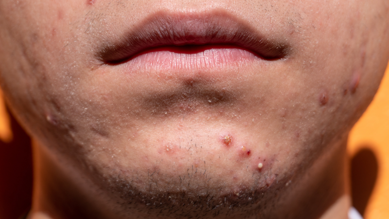 Tình trạng da thường xuyên xuất hiện các vết sưng mụn nhỏ cũng cho thấy bạn sở hữu làn da nhạy cảm