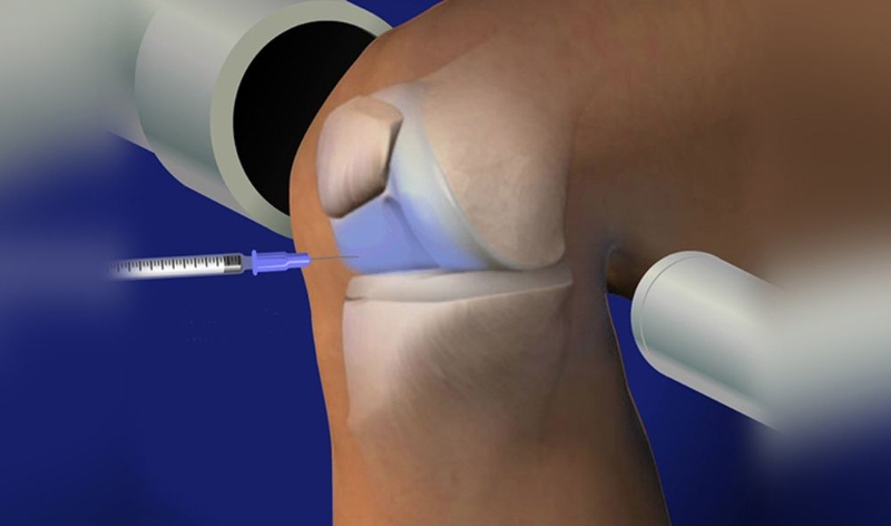 Tình trạng khớp gối kêu lạo xạo có nguy hiểm không? 4