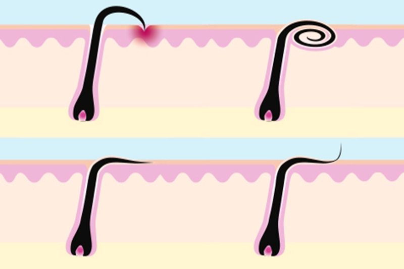 Tình trạng lông mọc ngược có hại không? 1