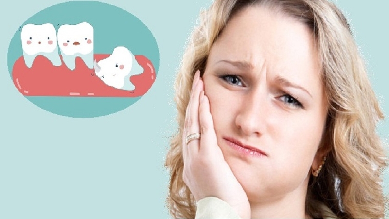 Tình trạng nhổ răng khôn bị sưng diễn ra trong bao lâu? 1