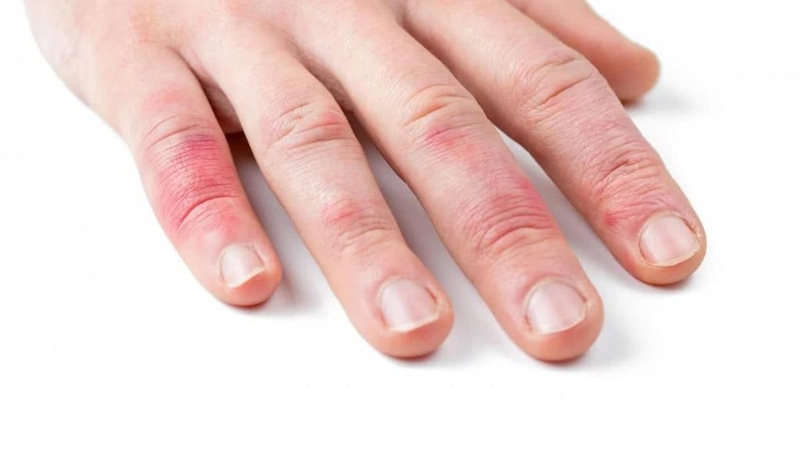 Tình trạng nổi mụn nước không ngứa là gì? Nguyên nhân từ đâu? 2