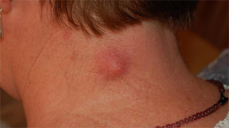 Tình trạng nổi mụn sau gáy: Nguyên nhân và cách điều trị 0