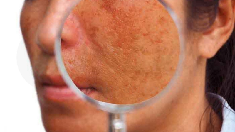 Sẹo đỏ bao lâu thì hết? Cách điều trị sẹo đỏ hiệu quả 5