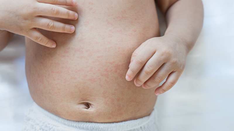 Rôm sảy ở trẻ em có thể dễ dàng nhận biết qua các biểu hiện trên da và thay đổi trong hành vi của trẻ