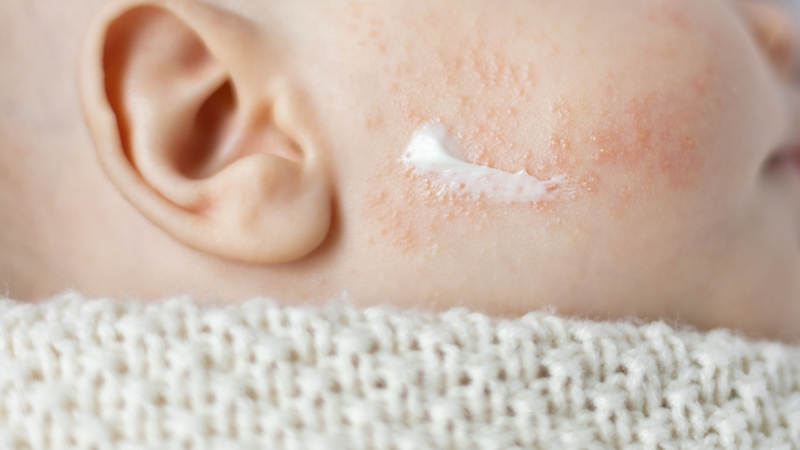 Nên tham khảo ý kiến của bác sĩ khi sử dụng các loại thuốc bôi cho trẻ