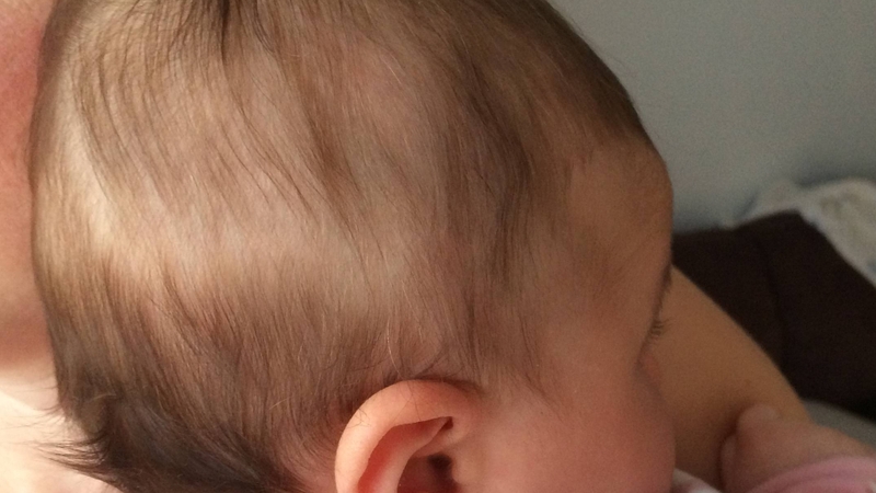 Trẻ sơ sinh rụng tóc vành khăn chỉ tình trạng tóc rụng thành một dải mảnh hình vòng cung quanh vùng chẩm