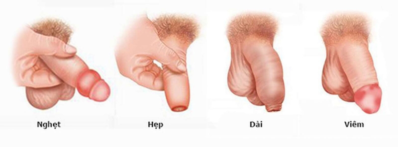 Dấu hiệu viêm bao quy đầu dễ nhận biết