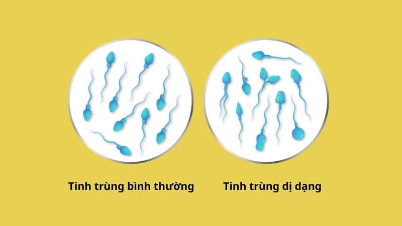 Tinh trùng dị dạng có thụ thai được không? Cách tăng khả năng thụ thai 1