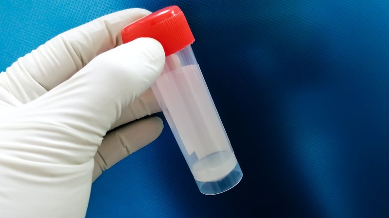 Xét nghiệm tinh dịch đồ giúp đánh giá chính xác khả năng di động của tinh trùng